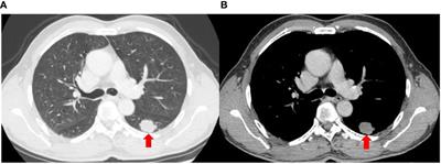 Successful treatment with tislelizumab plus chemotherapy for SMARCA4-deficient undifferentiated tumor: a case report